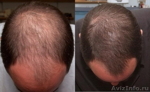 Лечение от выпадения волос - Изображение #1, Объявление #286853